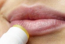 טיפול ומניעה: כך מתמודדים בהצלחה עם הרפס בשפתיים