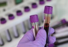 מחסור רפואי חדש: אין מספיק בדיקות לגילוי מחלת העגבת